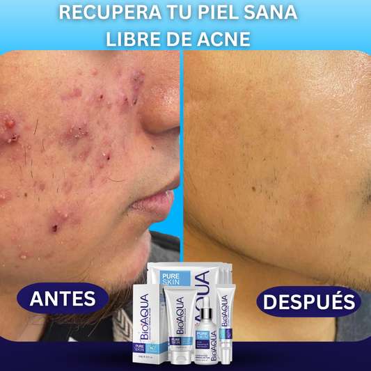 KIT ANTI ACNÉ BIOA+CAJA